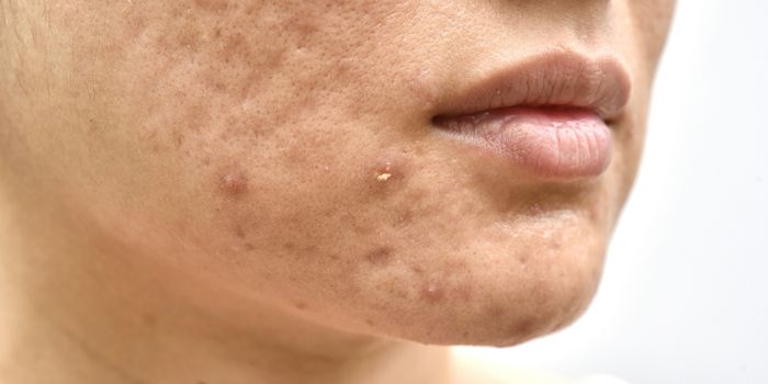 Stop les imperfections ! A vous la peau nette et fraîche !